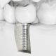 Dental Implants Need To Know