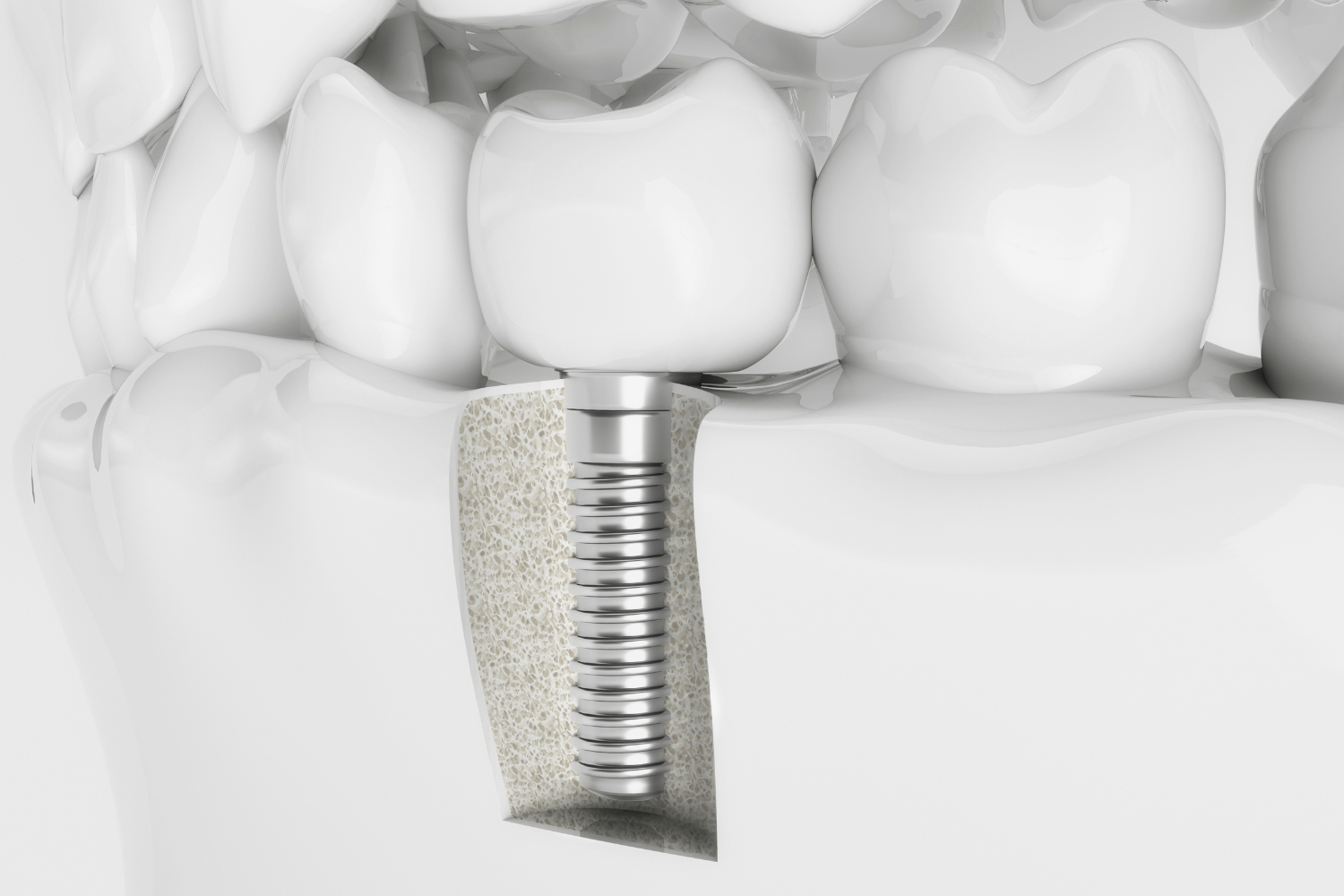 Dental Implants Need To Know