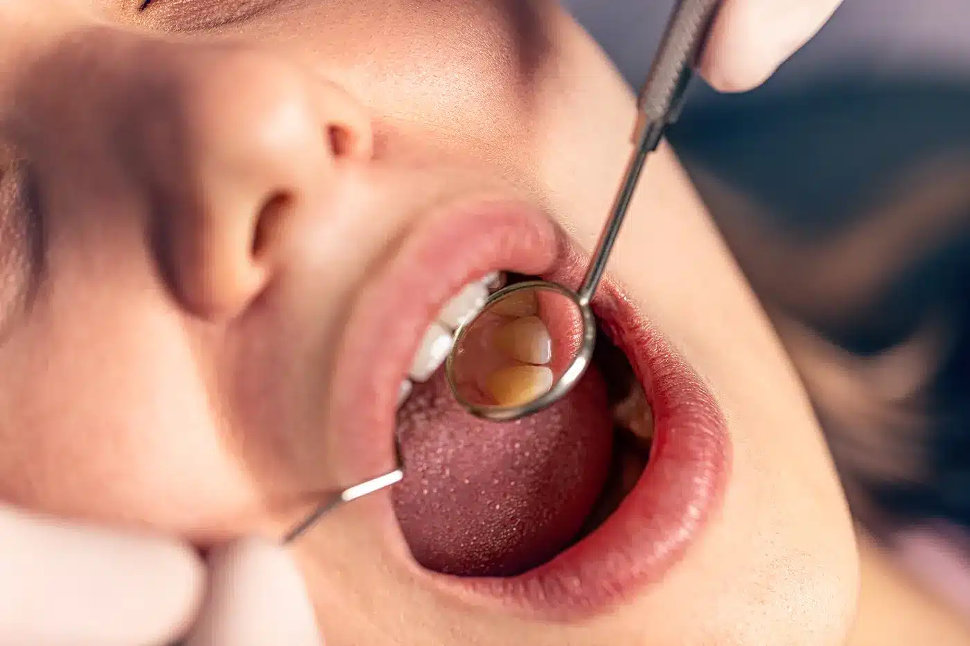 signs of cavities